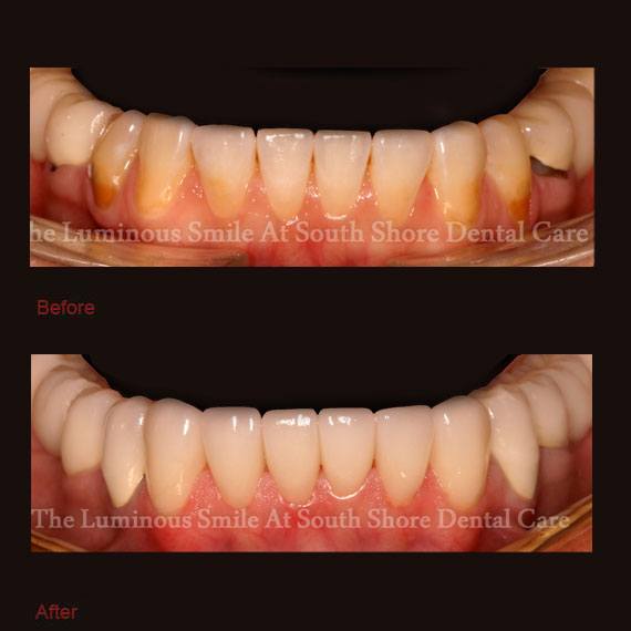 Worn discolored bottom teeth and veneers