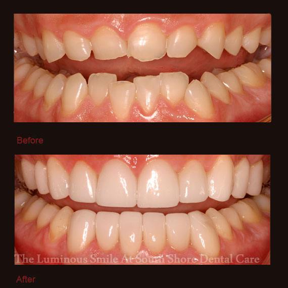 Chipped and crooked bottom teeth and veneers