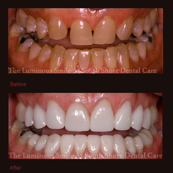 Cracked and worn bottom teeth and veneers