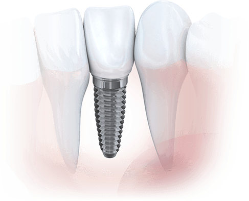 Drawing of dental implant
