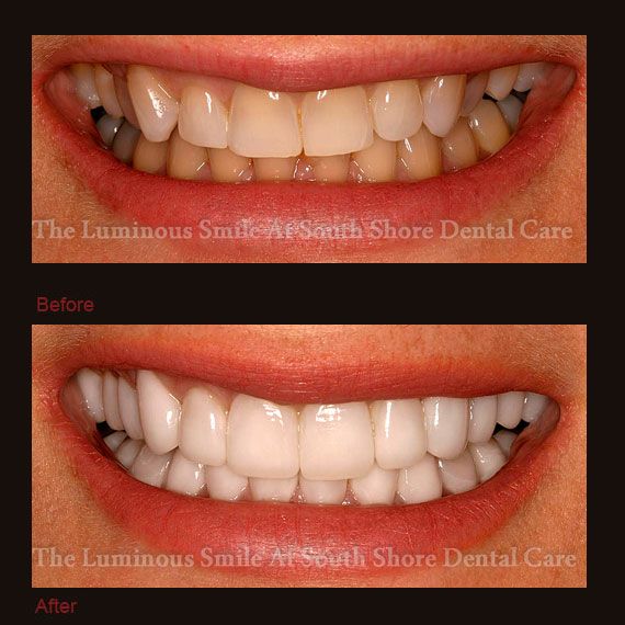 Before and after yellowed teeth and flawless lumineers