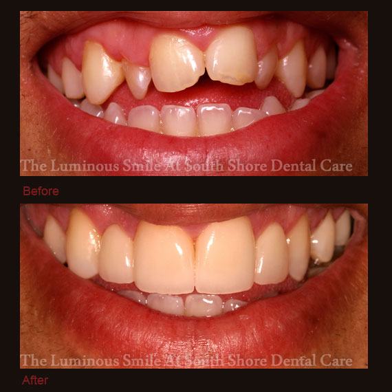 Before and after uneven smile line and flawless lumineers