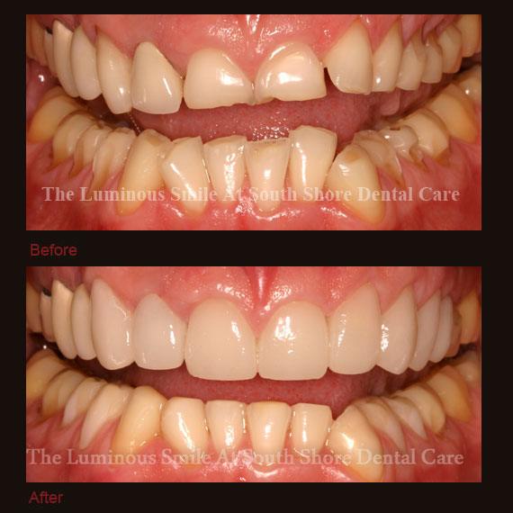 Before and after severely worn smile and flawless lumineers