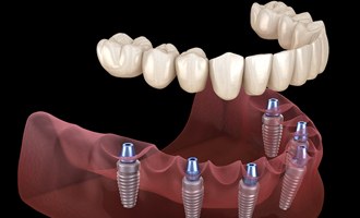 Implant dentures