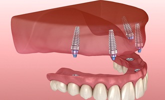 Dentures on dental implants