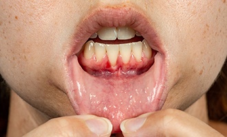 person pulling down their lip and showing an infected tooth