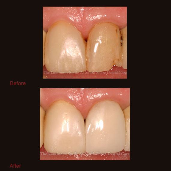 Decayed tooth repaired with bonding