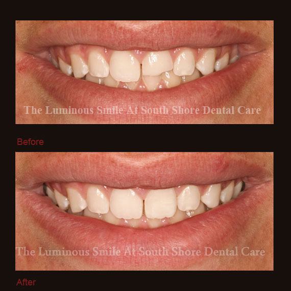 Broken tooth repaired with bonding
