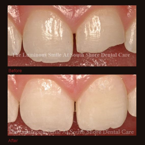 Closeup of broken tooth and bonding repair