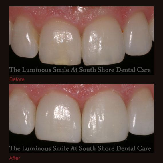 Decayed front tooth repaired with bonding
