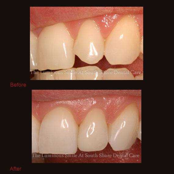 Misshapen tooth repaired with bonding