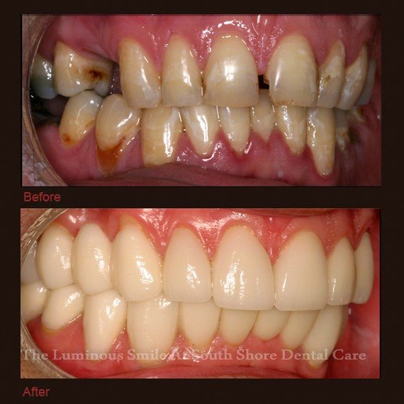 Missing tooth and replacement dental crown tooth