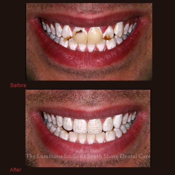 Before and after images discoloration and veneer treatment