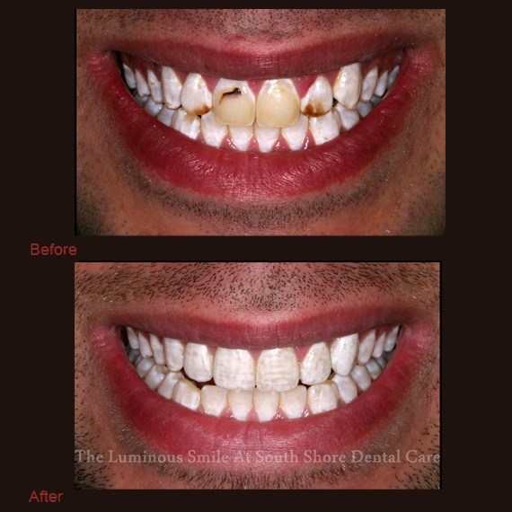 Before and after images discoloration and veneer treatment