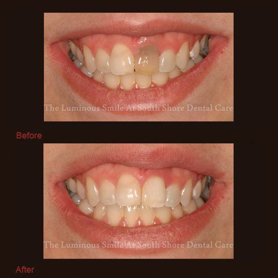 Dark colored front tooth and brightened teeth