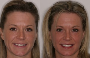 Before-and-after photo using porcelain veneers.