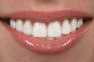 veneers