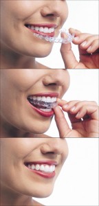 invisalign