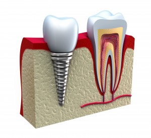 dental implant diagram