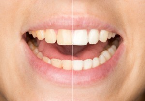 Zoom whitening in Massapequa