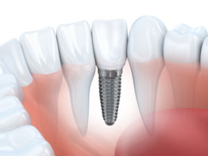 side view of dental implant