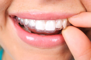 Invisalign clear aligners 