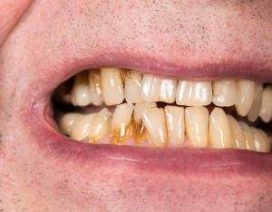 man grimacing with stained teeth