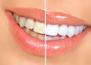 teeth before and after picture