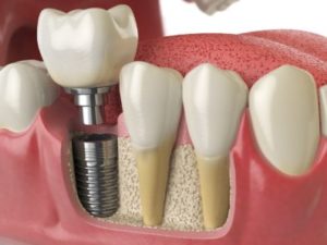 Anatomical figure of an implant in the lower jaw