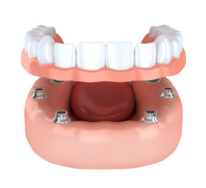 Implant-retained denture