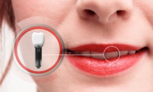 Dental Implants