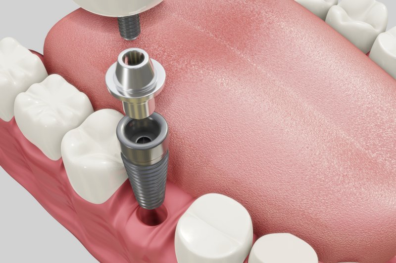 Titanium implant and abutment with crown being placed in mouth
