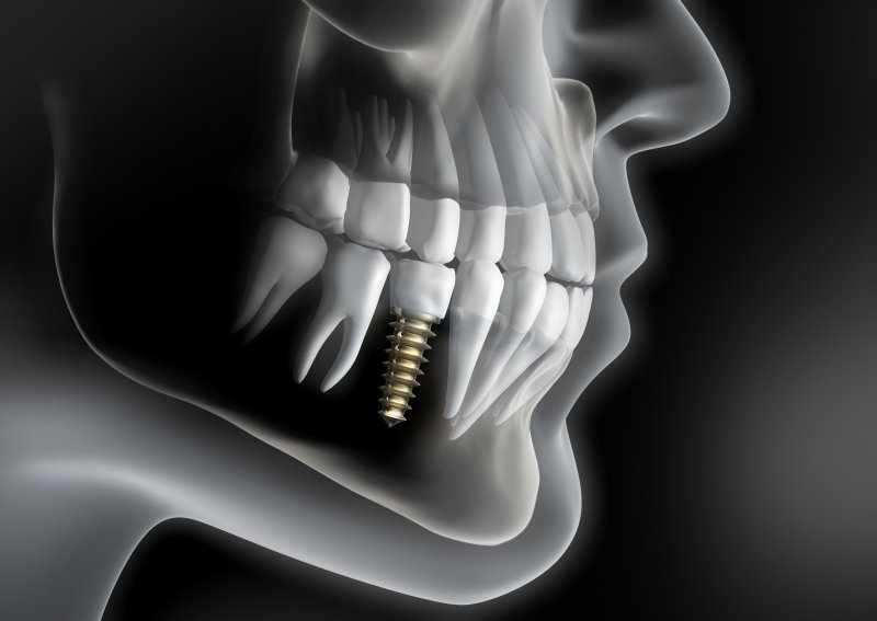 a digital skeleton with a dental implant on the lower arch