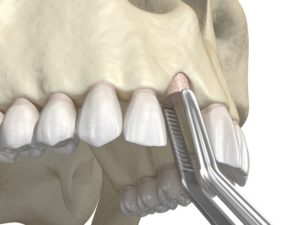 diagram of a bone graft