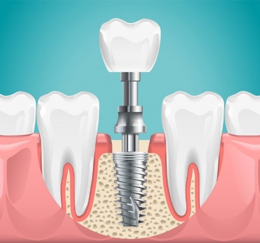 Dental implant diagram.