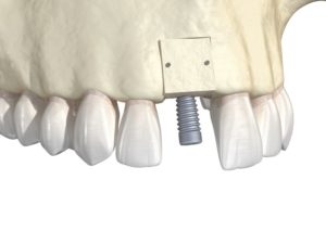 Illustration of block dental bone graft and dental implant
