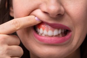 a woman showing her dentist her swollen gums