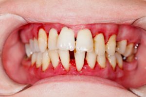 Patient with advanced gum disease