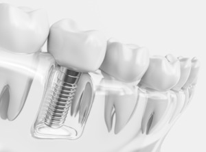 3D render of a dental implant