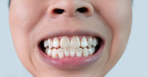 a closeup of a patient’s teeth with white spots 