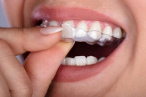 Close-up on clear aligner fitting over teeth.