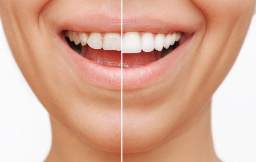 Veneers before and after photo