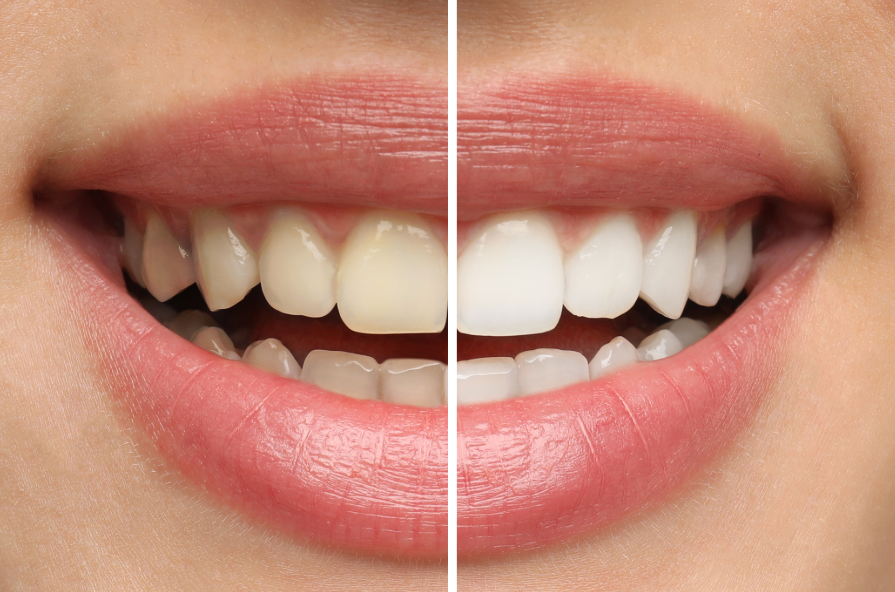 Close up of woman's smile with half yellow teeth, half white teeth